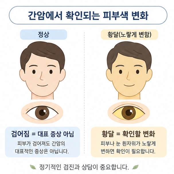 얼굴이 검어지는 것은 간암의 대표 증상이 아니며 피부와 눈이 노랗게 변하는 황달을 구분해 보여주는 이미지