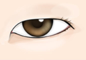 몽고주름으로 좁은눈