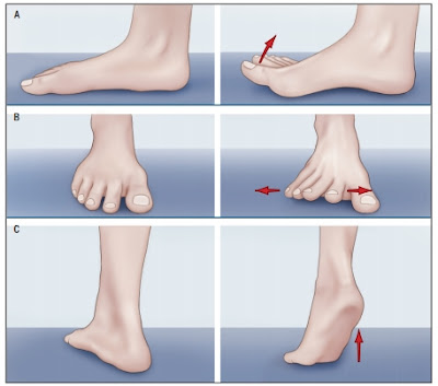 무지외반증 운동