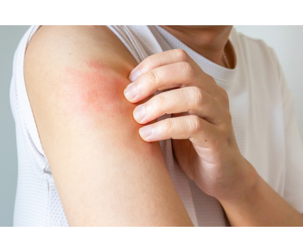 몸이 가려운 이유 5가지와 원인별 예방·대처법