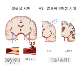 혈관성치매 원인 증상 치료법과 예방 생활습관_23