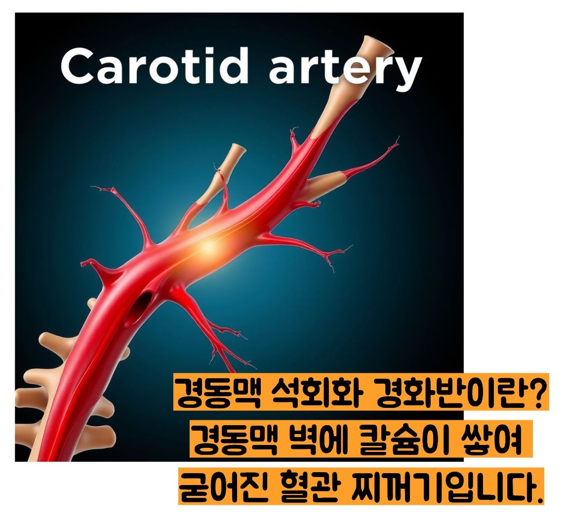 경동맥 석회화 경화반