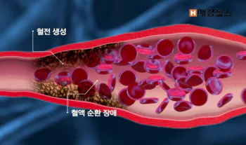 혈관질환-예방