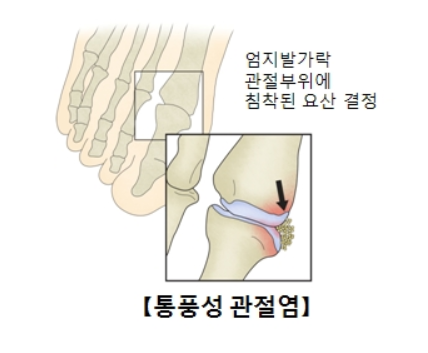 통풍 초기증상 원인 검사 치료방법