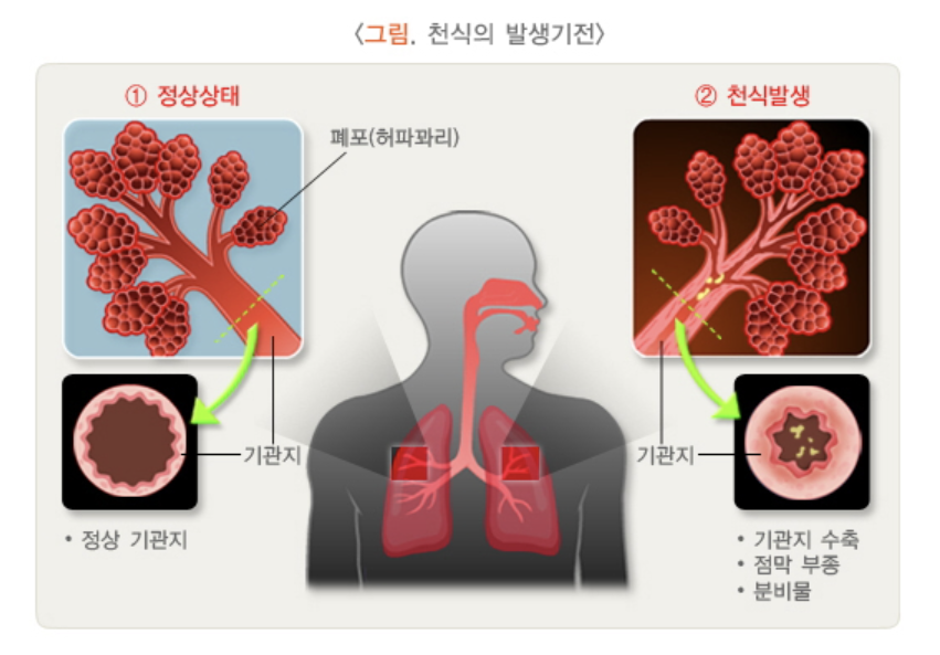 천식의 발생기전