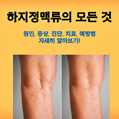 하지정맥류의 모든 것, 원인과 증상 진단 및 치료, 예방법까지!