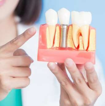 임플란트 가격 비교 사이트별 비용 총정리