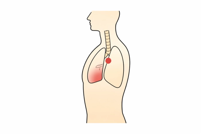 암환자 산정특례 제도