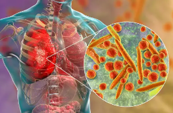 마이코플라즈마 폐렴