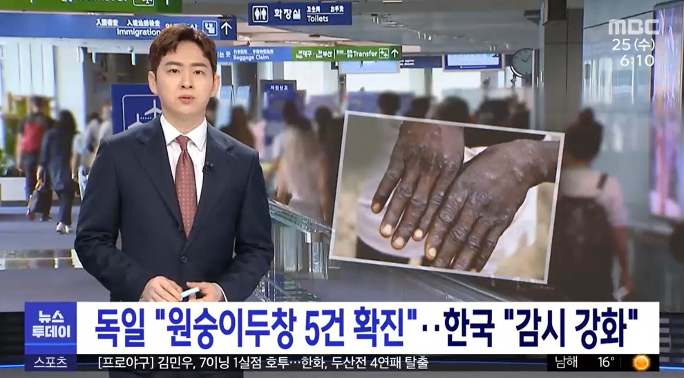 원숭이두창 현상황 증상 관련주