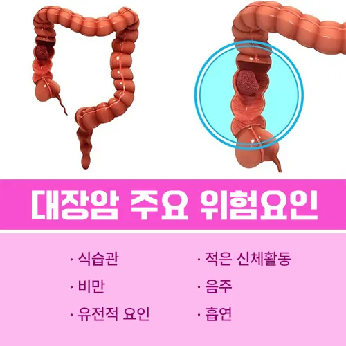 대장암 원인