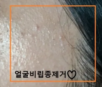 비립종 생기는 이유 비립종 없애는 방법 피부 관리법_12