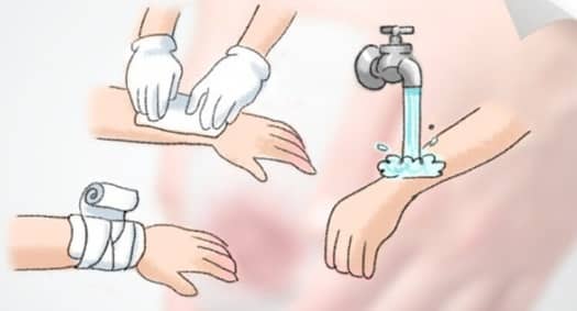 스포츠 손상에서 발생하는 창상의 응급 처치 방법