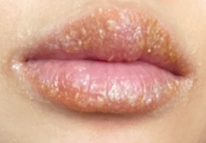 박탈성구순염-상태악화-물집-딱지