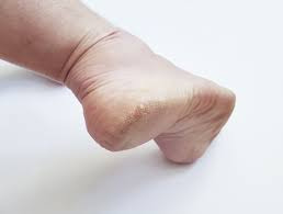 발각질제거원리와방법