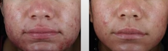 아클리프-크림으로-여드름-없애는-방법