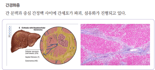 B형 간염 정의 특징 치료 예방