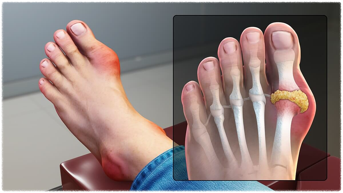 통풍 증상 치료법 초기증상 원인