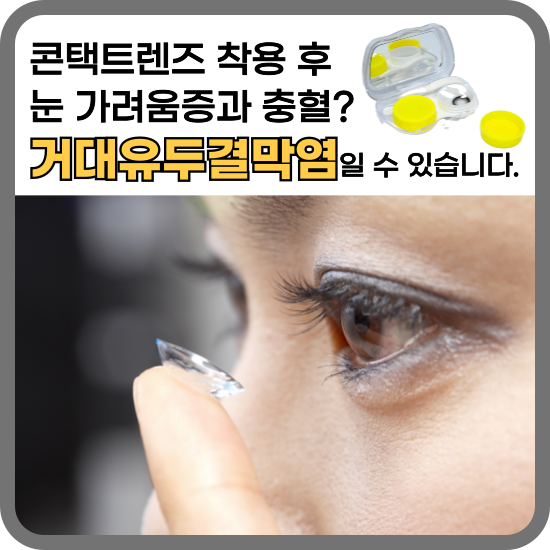 거대유두결막염