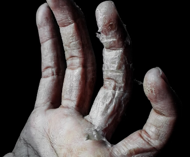 비오틴 부작용 : 피부