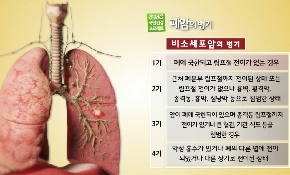 EBS명의-폐명의-심태선-교수