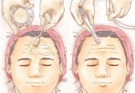이마 주름 없애는 법