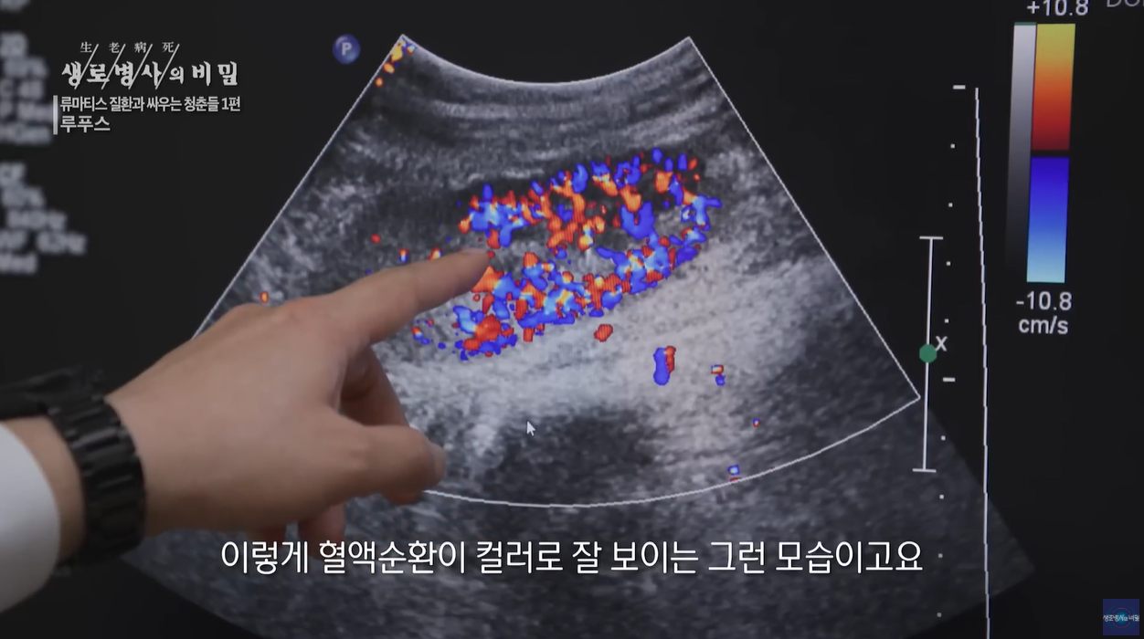 루프스 천의얼굴 동행의병 제2의삶 관리의시대