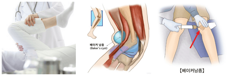 무릎 스트레칭, 베이커낭종 사진
