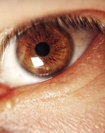 안구건조증 눈의 모습