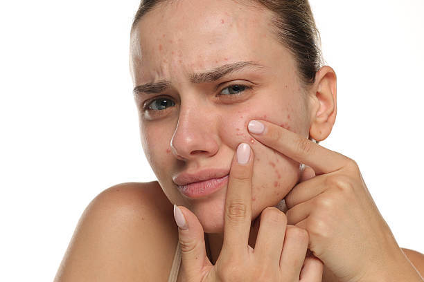 집에서 짜는 여드름 NO! 피부과 압출이 필요한 이유?