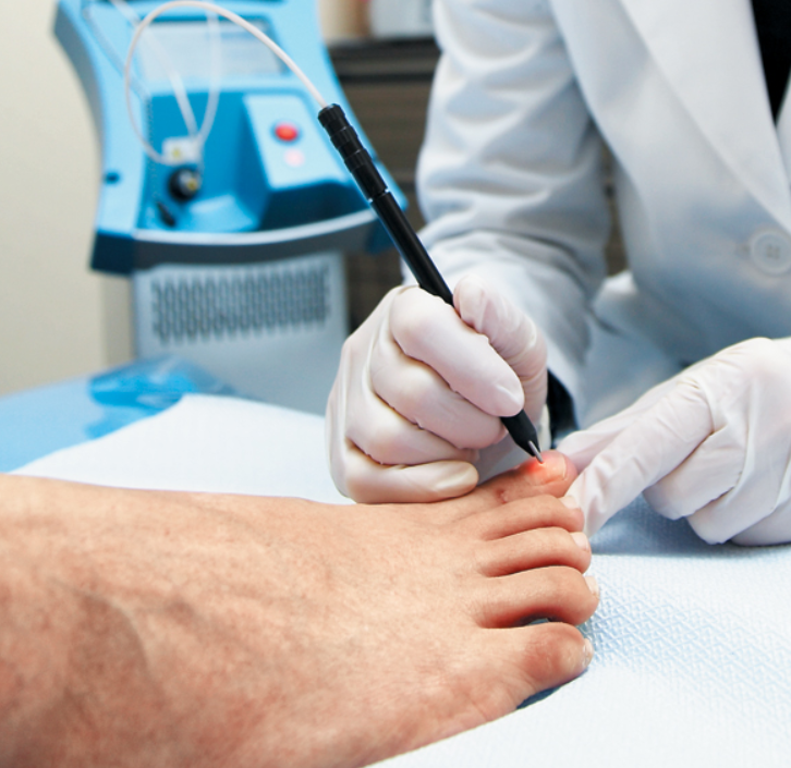 발톱무좀 레이저 치료를 받고 있는 사진