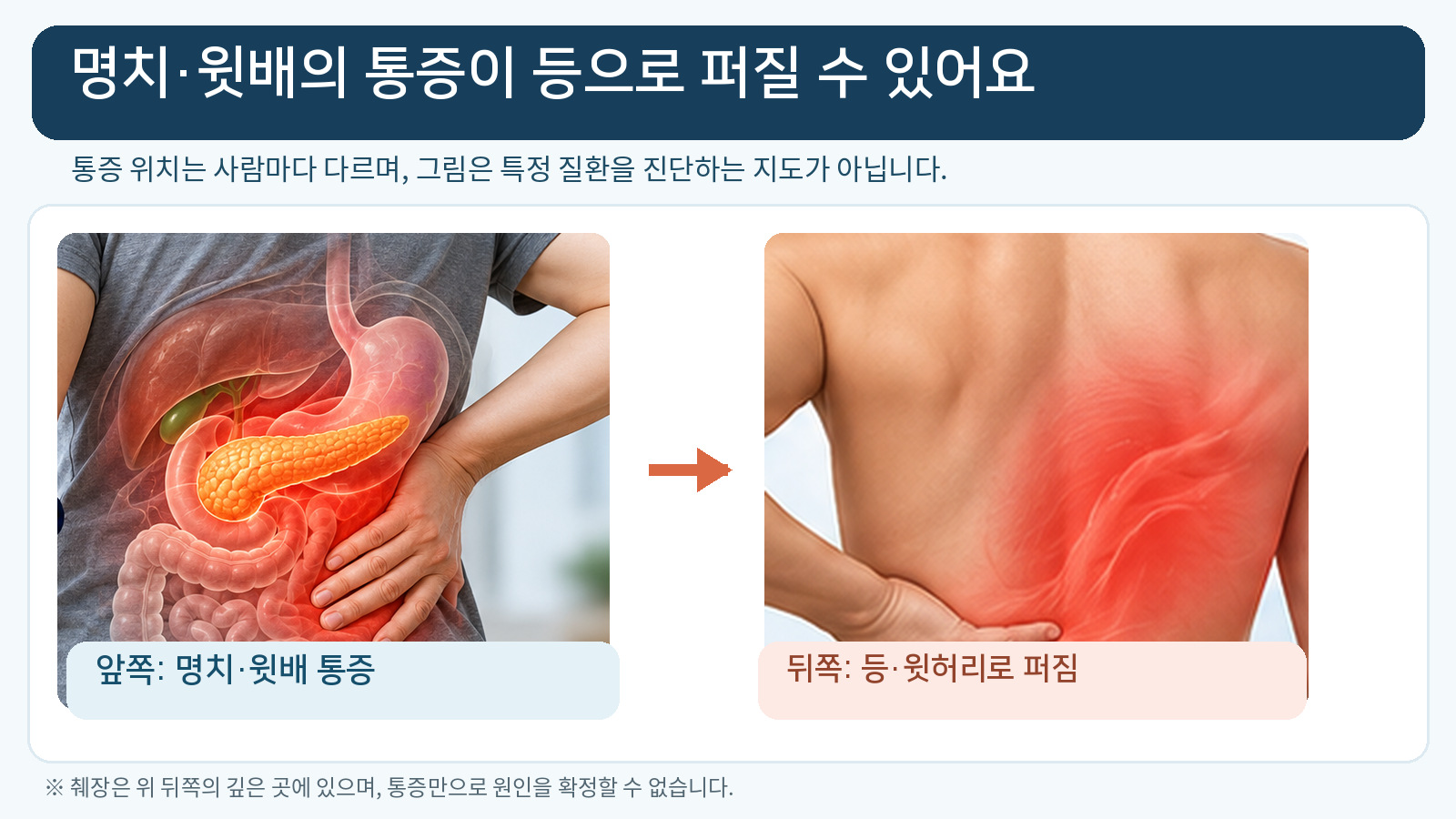 췌장의 앞쪽 위치와 명치 윗배 통증이 등과 윗허리로 퍼지는 개념을 비교한 교육용 일러스트