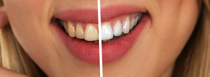 치아가-변색되는-꿈-사진