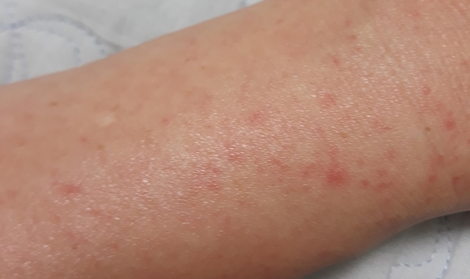 알레르기 피부염