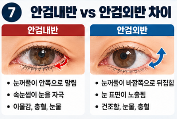 안검내반 안검외반 차이