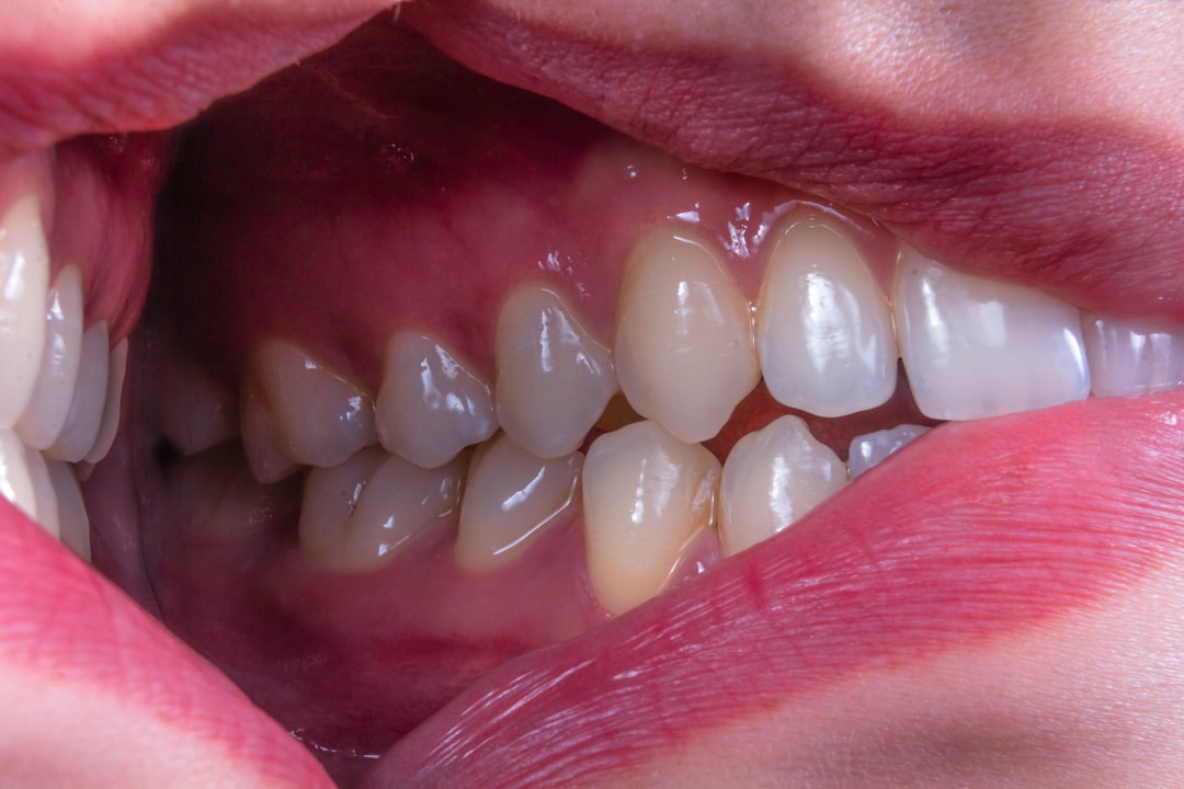 Gingivitis
