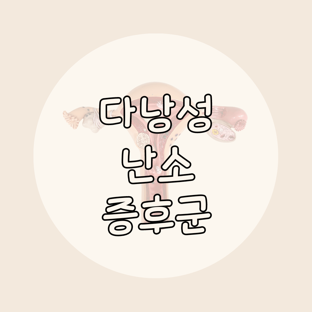 다낭성 난소 증후군