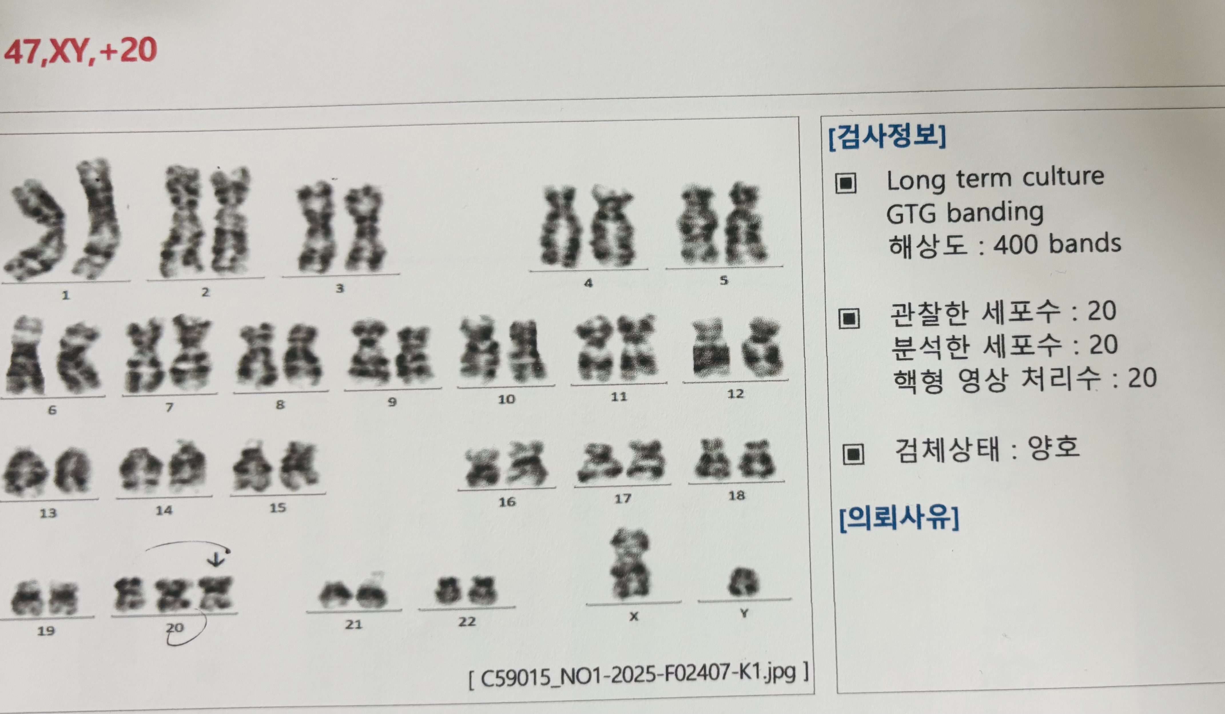 POC검사 (반복유산, 진행방법, PGT치료)