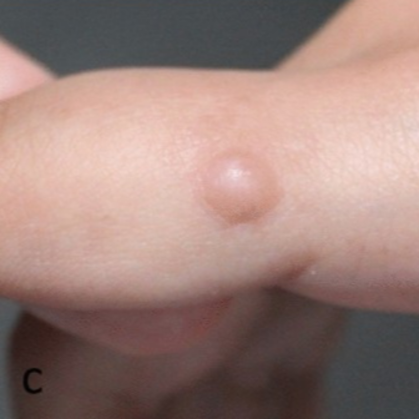 신경섬유종 초기 증상, 혹시 나도? 놓치면 안 되는 신호