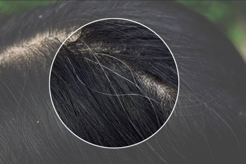 탈모 예방 혈자리