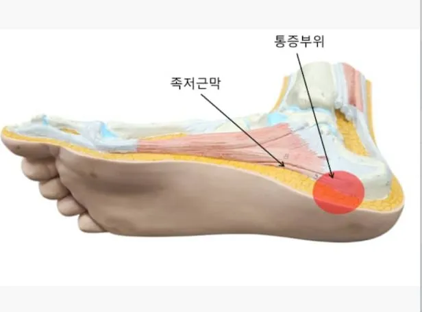발바닥통증의 원인들과 해결책_9