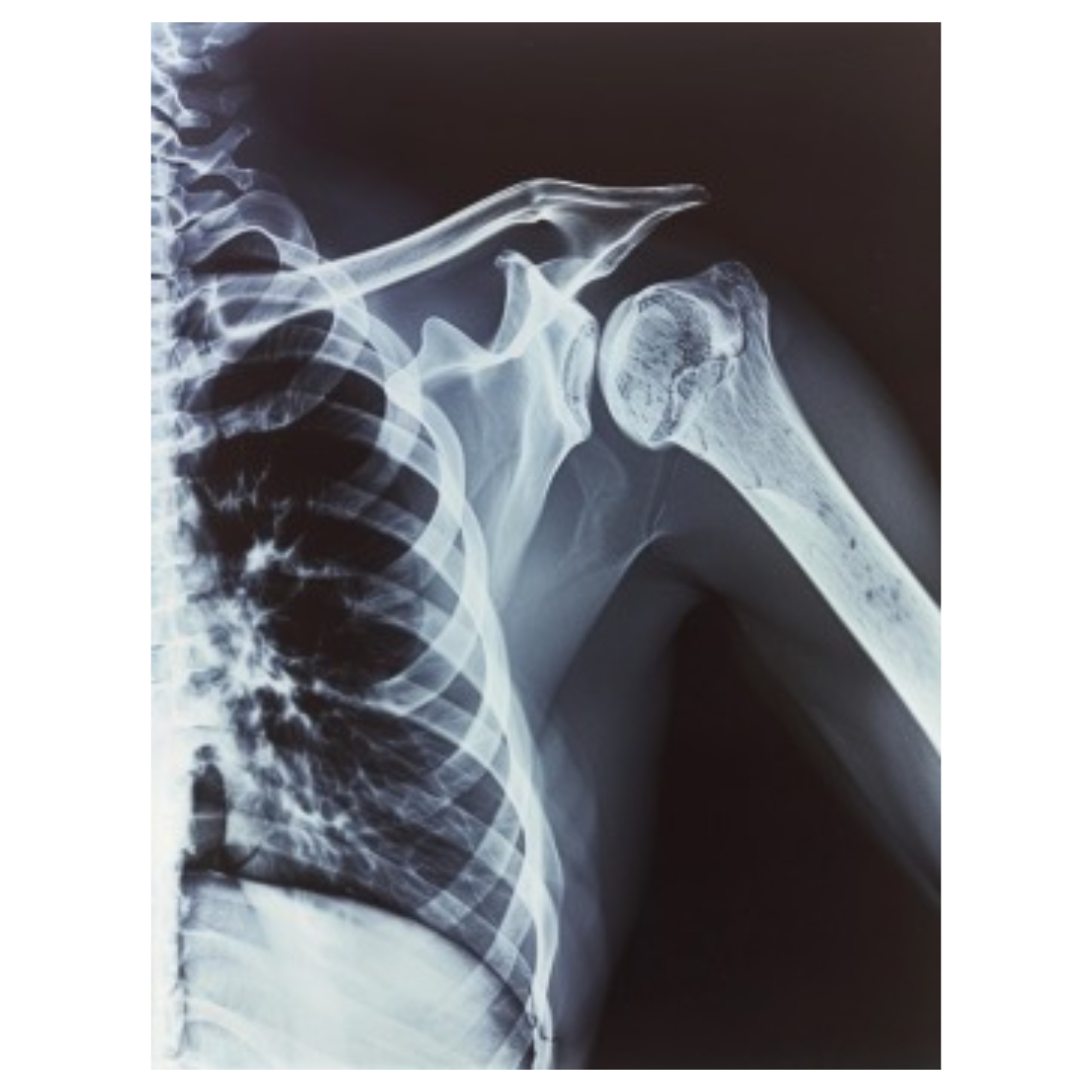 어깨통증과 관련된 사진입니다.