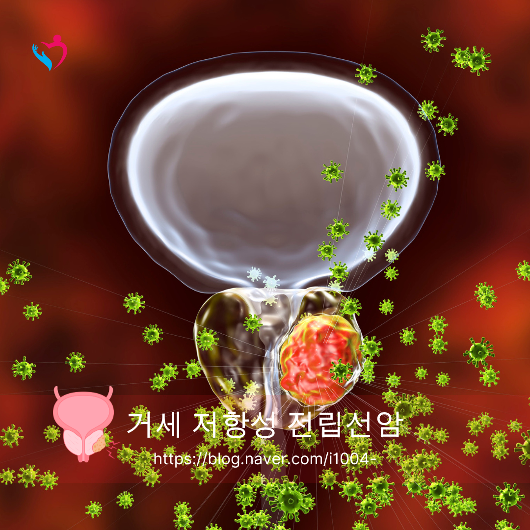 최신 의료 루테슘(Lu-177) PSMA 거세 저항성 전립선암 치료에 대해