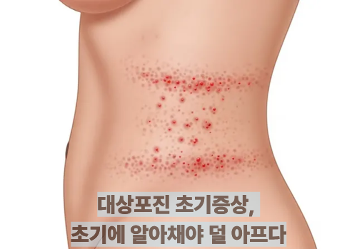 대상포진 초기증상, 초기에 알아채야 덜 아프다