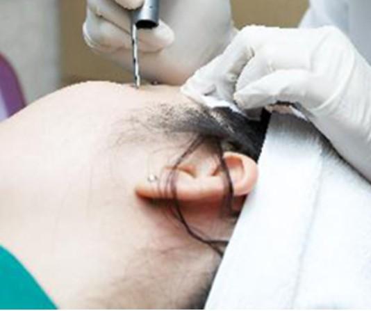 편평사마귀 없애는 방법