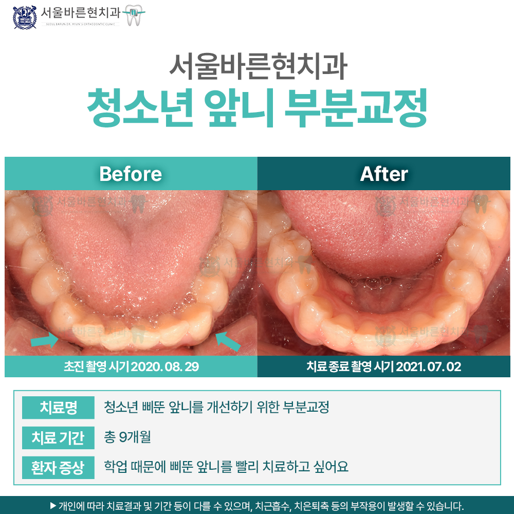 해운대청소년앞니교정
