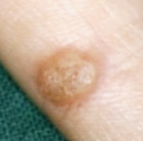 사마귀 원인과 제거방법