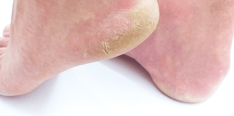 발바닥이 갈라진 모습