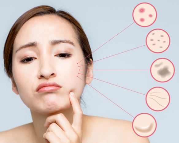 검버섯-제거-크림