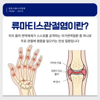 효과적인 류마티스 관절염 치료제 추천 약물 비교 가이드 2025 최신판_6